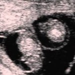 Twin Pregnancy Scan from Reprodoc